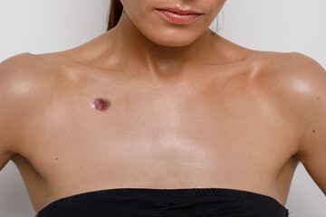 acne close-up on the female breast, problematic teenage skin - obrazy, fototapety, plakaty