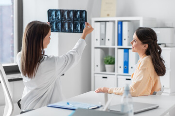 medicine, healthcare and people concept - smiling female doctor or vertebrologist showing x-ray image of spine to woman patient at hospital