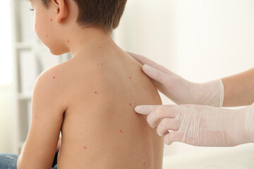 Doctor examining little boy with chickenpox in clinic, closeup. Varicella zoster virus