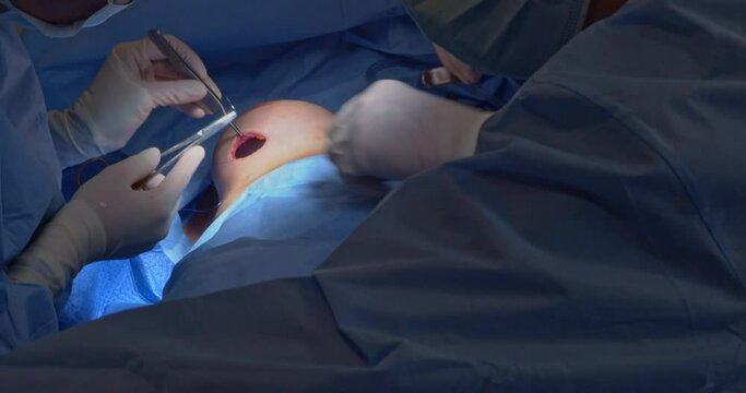 Breast implant replacement. Plastic surgery. Wound suturing