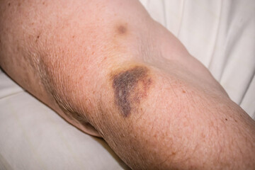 Naklejka premium Hand of an old woman with hematomas after an intravenous injection