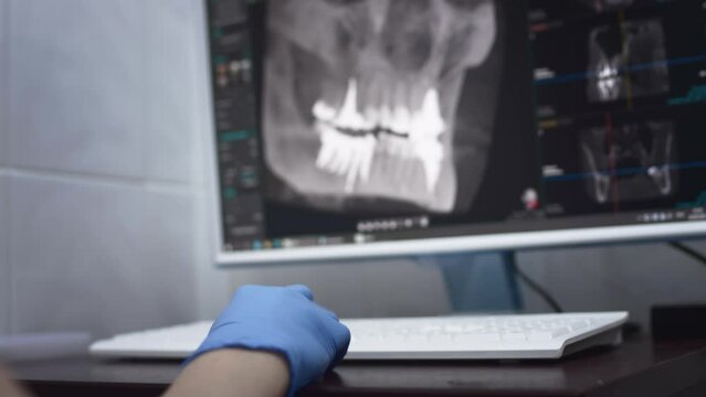 The doctor studies the 3D model of the jaw. A doctor looks at a jaw scan in a dentist's office. Modern technologies in medicine. Uses a computer to treat a patient