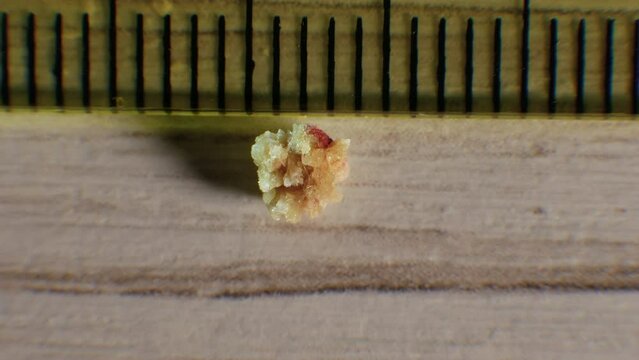 Oxalate kidney stone 4 mm, the stone was removed from the kidney, close-up of the kidney stone. Natural stone formed in the human kidney