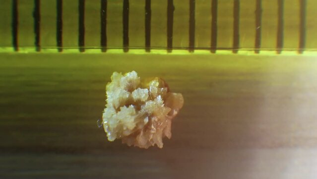 Soft focus Oxalate kidney stone, stone removed from the kidney, kidney stone close-up. Natural stone formed in the human kidney, after the operation of the stone..