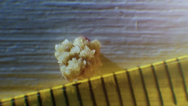 Soft focus Oxalate kidney stone, stone removed from the kidney, kidney stone close-up. Natural stone formed in the human kidney.