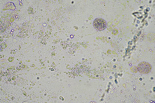 Person With A Virus Coughing, Phlegm And Mucus Under The Microscope