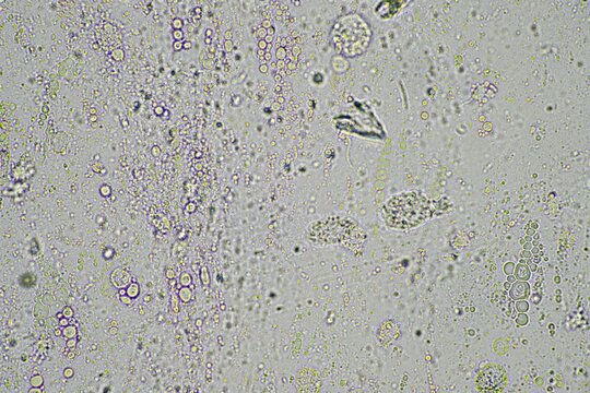 Coughing Up Mucus And Phlegm From A Chest Infection From A Virus And Bacteria Infection, Looking At It Under The Microscope, With Cells And Microorganisms. Bacteria And Skin Cells Close Up