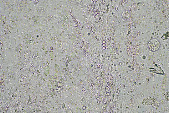 Coughing Up Mucus And Phlegm From A Chest Infection From A Virus And Bacteria Infection, Looking At It Under The Microscope, With Cells And Microorganisms. Bacteria And Skin Cells Close Up