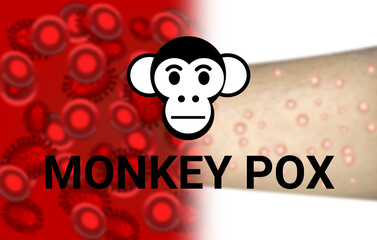 monkey pox virus pendamic background with blur infected hand and virus in blood.