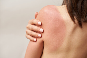 Sunburn on female shoulder, skin care and protection concept