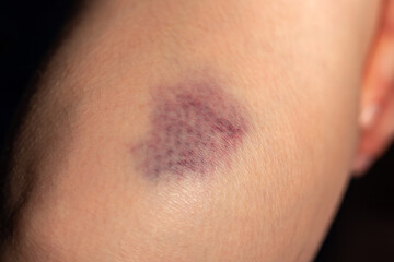 Fototapeta premium Photo of the bruise on woman leg