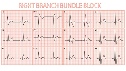 12 Lead ECG - Right Branch Bundle Block
