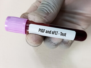 Blood sample for placental growth factor or PIGF and Soluble fms-like tyrosine kinase or sFLT test in laboratory.