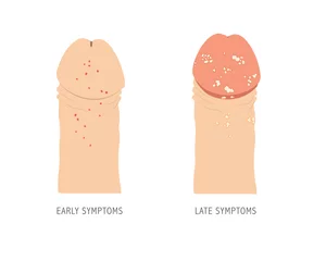Fotobehang Human penis with early and late symptoms of STD genital herpes. Medical illustration for infographic. © Maryna Vladymyrska