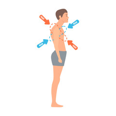 Upper crossed syndrome medical diagram. Crooked man with muscle strength imbalance. Weak and overactive muscles therapy. Incorrect spine curvature caused by bad posture. Vector illustration.