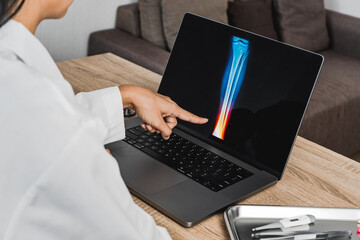 Close up of doctor showing a x-ray of ankle. Pain ankle injury