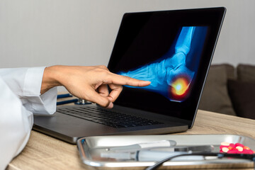 Close up of doctor showing a x-ray of foot. Pain heel and foot injury