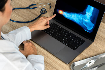 Close up of doctor showing a x-ray of foot. Pain toes injury