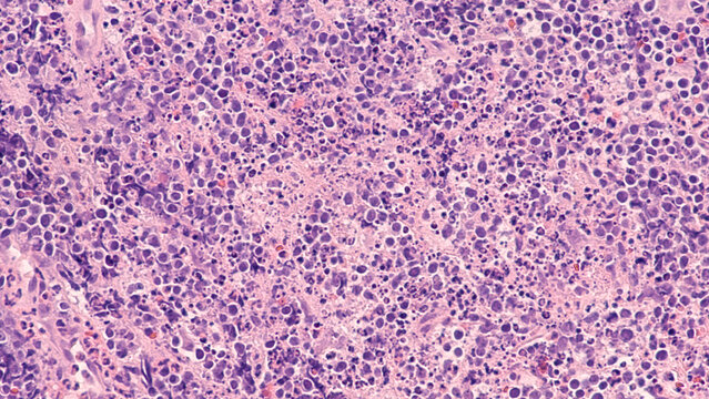 Burkitt lymphoma is a rare but highly aggressive (fast-growing) B-cell non-Hodgkin lymphoma (NHL).