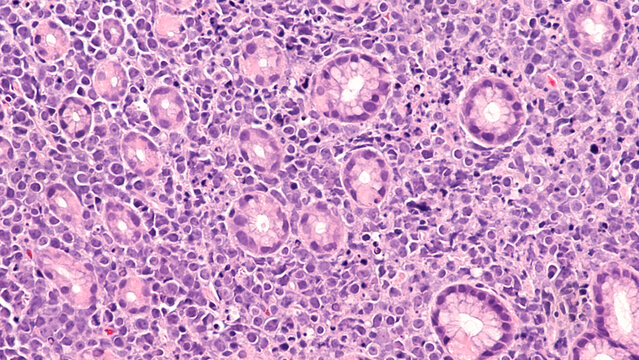 Photomicrograph showing pathology of Burkitt lymphoma, a rare but highly aggressive (fast-growing) B-cell non-Hodgkin lymphoma (NHL), involving colon.