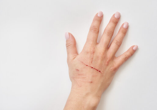 Female hand with cat scratches