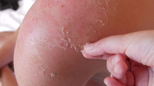 Sunburn: Closeup of Peeling sunburned skin on back and shoulder. Skin peels off after the strong sun. The hand helps to peel off the burnt skin from a sunburn.
