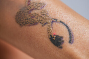 Young woman undergoing laser tattoo removal procedure in salon, closeup.