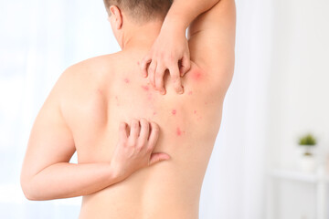 Teenager ill with monkeypox scratching his back