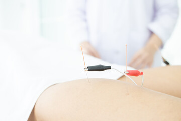 close up woman undergoing acupuncture treatment with electrical stimulation.