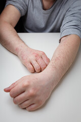 Fototapeta premium Allergy, red itchy rash on male hands and arms on white table. Dermatological problem, skin symptom of patient.