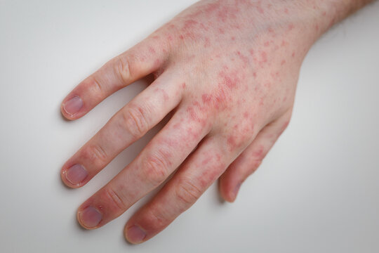 Allergy, Red Itchy Rash On Male Hand On White Table. Dermatological Problem, Skin Symptom Of Patient. Close Up Shot