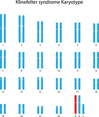Klinefelter syndrome (XXY) human karyotype