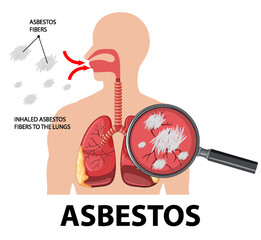 Diagram showing asbestosis in lungs