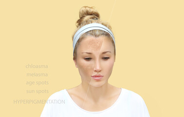 Hyperpigmentation: chloasma, melasma , age spots,Post-inflammatory...