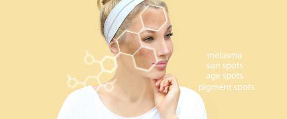 Hyperpigmentation: chloasma, melasma , age spots,Post-inflammatory hyperpigmentation.Hyperpigmentation removal