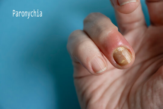 Swollen finger on a white background. Th... | Stock Video | Pond5