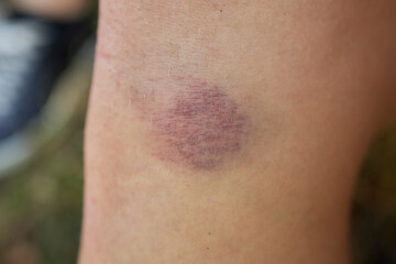 Bruise on the leg of a woman. A bruised leg. Close-up.