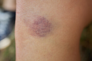 Bruise on the leg of a woman. A bruised leg. Close-up.