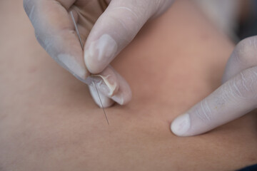 accupuncture to treat office syndrome