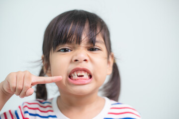 little Asian girl showing her broken milk teeth.