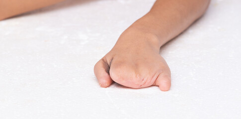 Disabled person hand without fingers since childhood brith, no thumb nail on white background isolated. Woman hands handicap show gesture look disability with arm and surgery wound to split finger