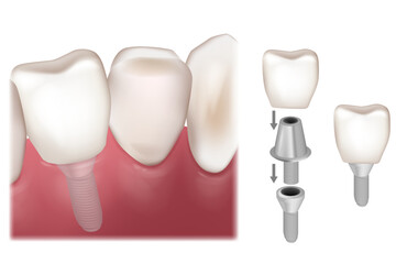 Dental Implant Recovery. Premolar tooth crown installation over implant abutment. Premolar tooth recovery with implant. Medically vector illustration of human teeth.