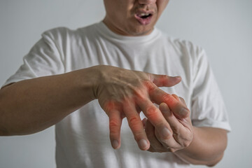 Man hand suffering from joint pain with gout in finger. cause of pain include rheumatoid arthritis,...