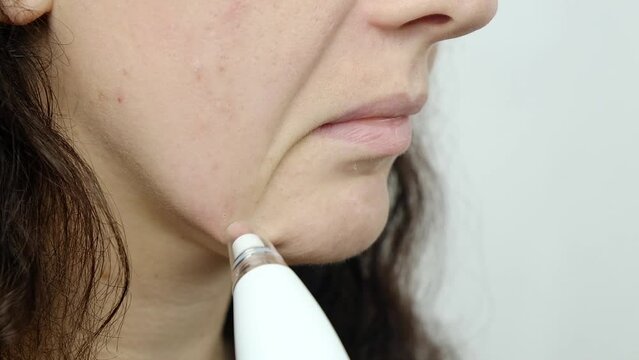 woman face and vacuum face pore cleaner, cosmetic skin care High quality FullHD footage