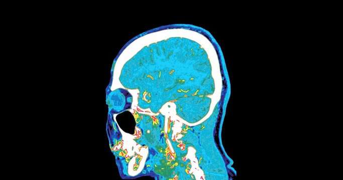 CTA Brain SCAN of the brain in colorful mode or PET CT Scan colorful.	