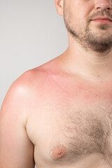 Obraz premium Skin of a person with sunburn, redness of the skin, close-up.