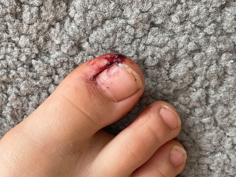 Nail injury at big toe. Toe wound closeup, top view