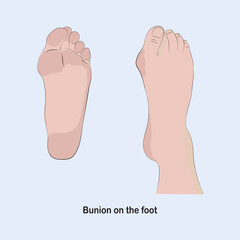 Bunion in the foot, causes the base of the toe to be pushed out of its normal position.