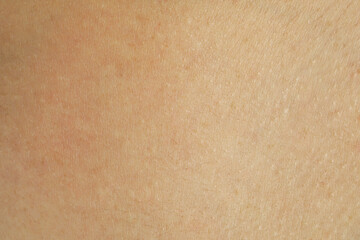 Texture of human skin with birthmarks, closeup view