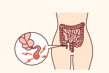 Closeup of human body with inflamed appendix. Person suffer from appendicitis need surgery. Vector illustration. 